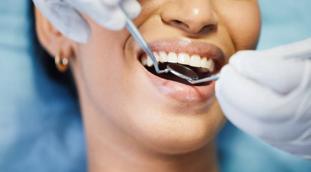 Best Emergency Wisdom Tooth Extraction in Bunker Hill, OR